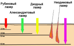 лучшая лазерная эпиляция